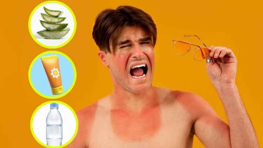 ¿Cómo aliviar los síntomas de las quemaduras por el sol?